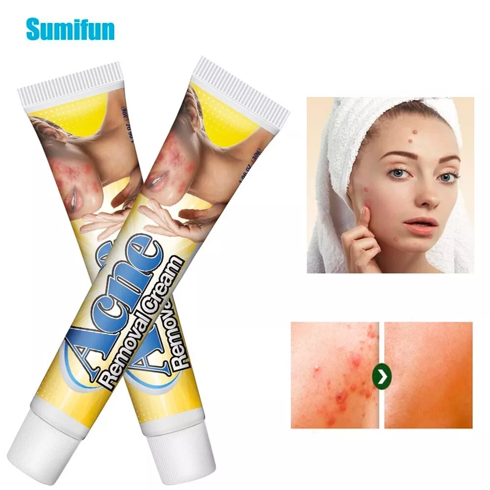 كريم إزالة حب الشباب من Sumifun - علاج فعّال وآمن للبشرة المعرضة لحب الشباب - يرطب، يفتح، ويزيل البقع خلال 4 أسابيع