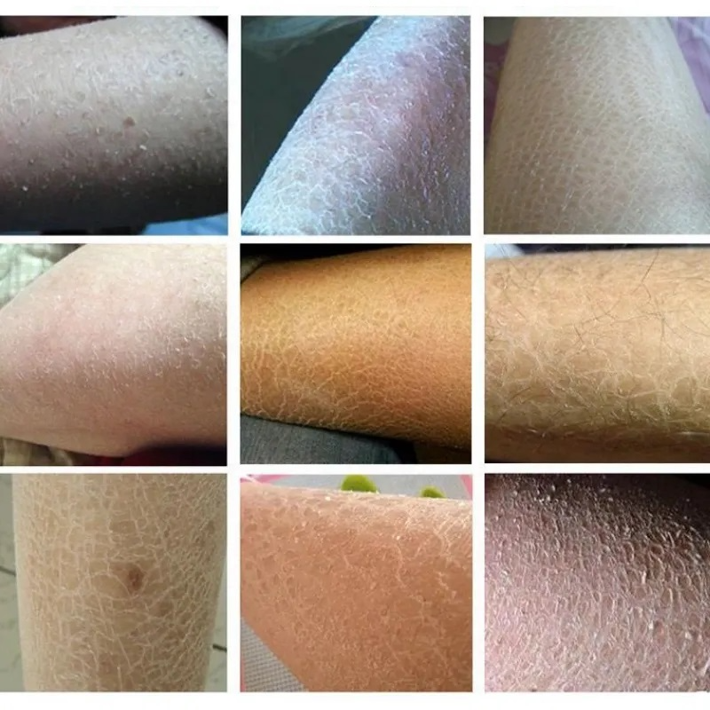 كريم Skin Chaps لعلاج جفاف الجلد وتشققاته – كريم موز طبيعي بتركيبة عشبية لتنعيم وتفتيح البشرة 20غ