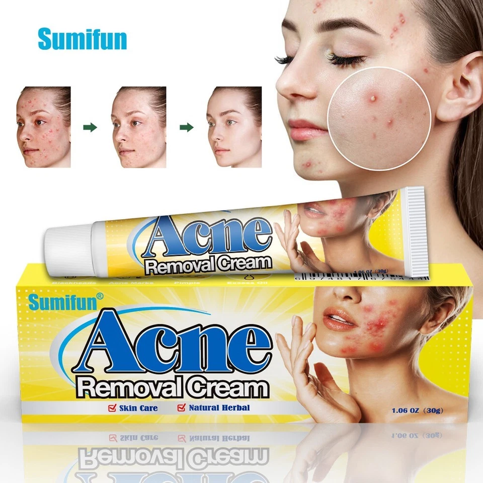 كريم إزالة حب الشباب من Sumifun - علاج فعّال وآمن للبشرة المعرضة لحب الشباب - يرطب، يفتح، ويزيل البقع خلال 4 أسابيع