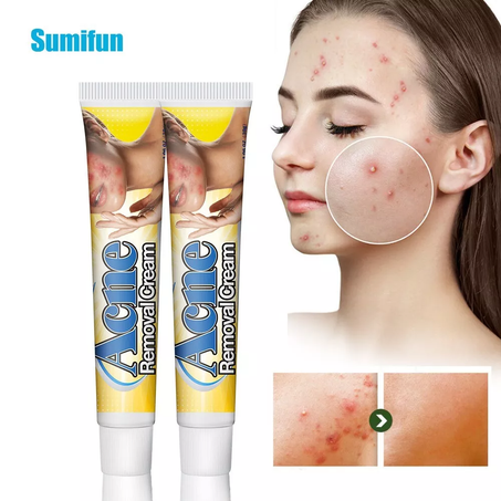 كريم إزالة حب الشباب من Sumifun - علاج فعّال وآمن للبشرة المعرضة لحب الشباب - يرطب، يفتح، ويزيل البقع خلال 4 أسابيع