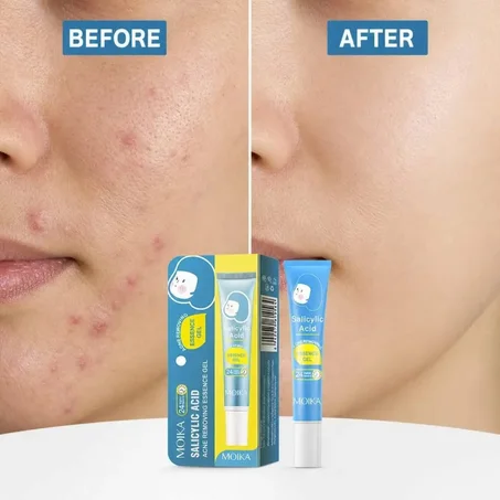 GEL ACIDE SALICYLIQUE ANTI-ACNÉ MOIKA
