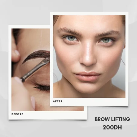 BROW LIFT