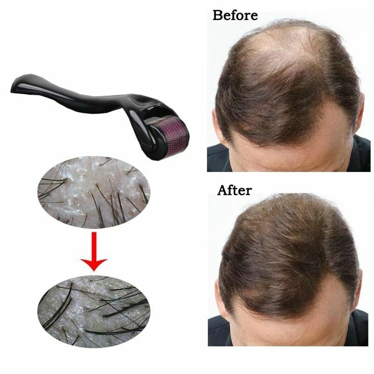 Derma roller