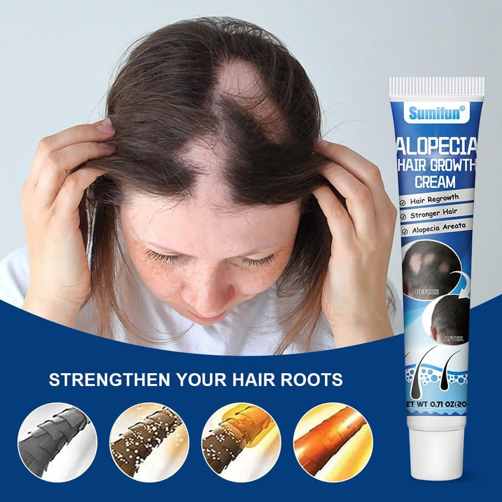 Alopecia cream  لعلاج داء الثعلبة و تساقط الشعر