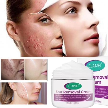 كريم إزالة اتار حب شباب  Scar Removal Cream