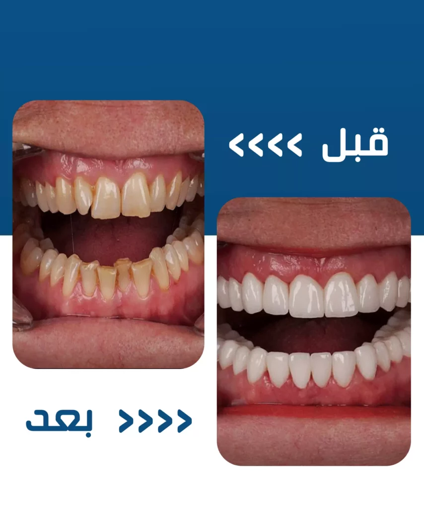 SNAP ON SMILE