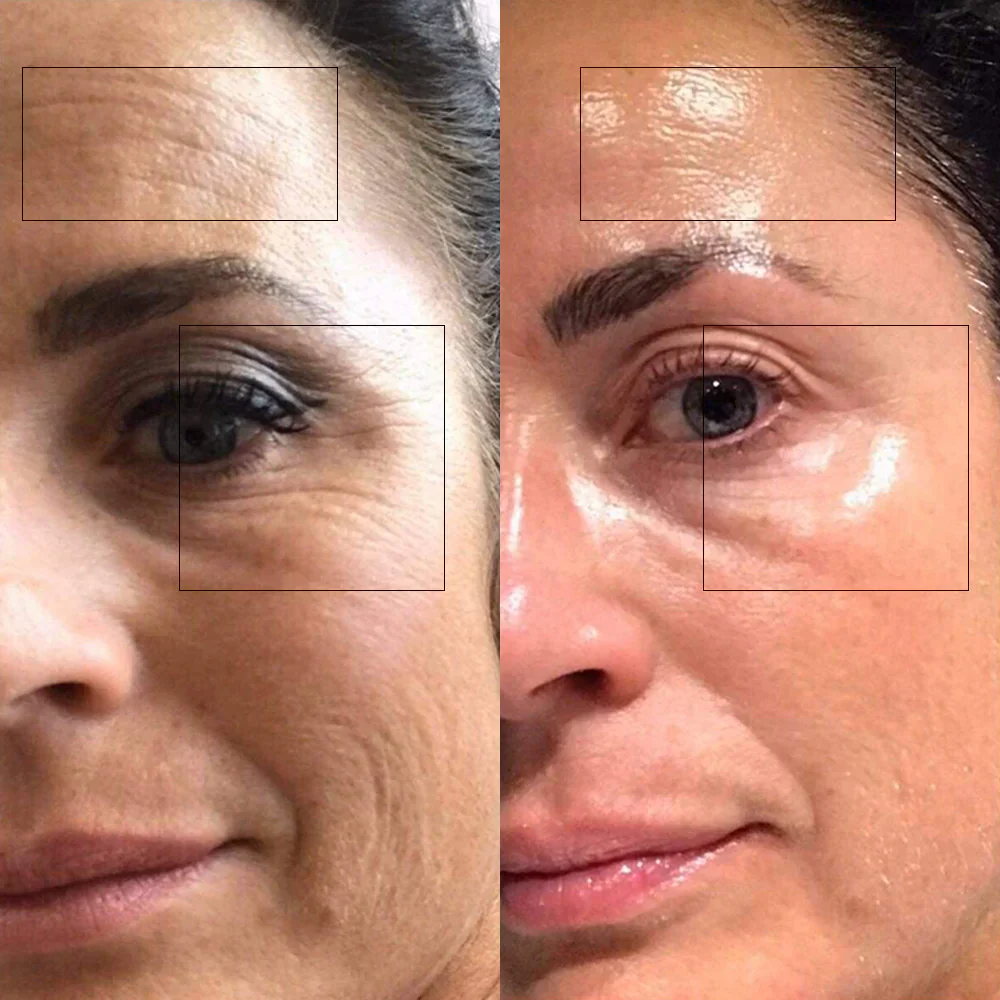 🌟 Nano Collagen Face Lift Kit – Smooth, Tighten & Glow!
