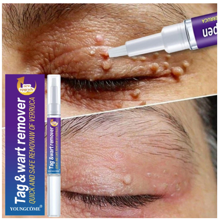 قلم مضاد للجراثيم لازالة الثآليل بسهولة