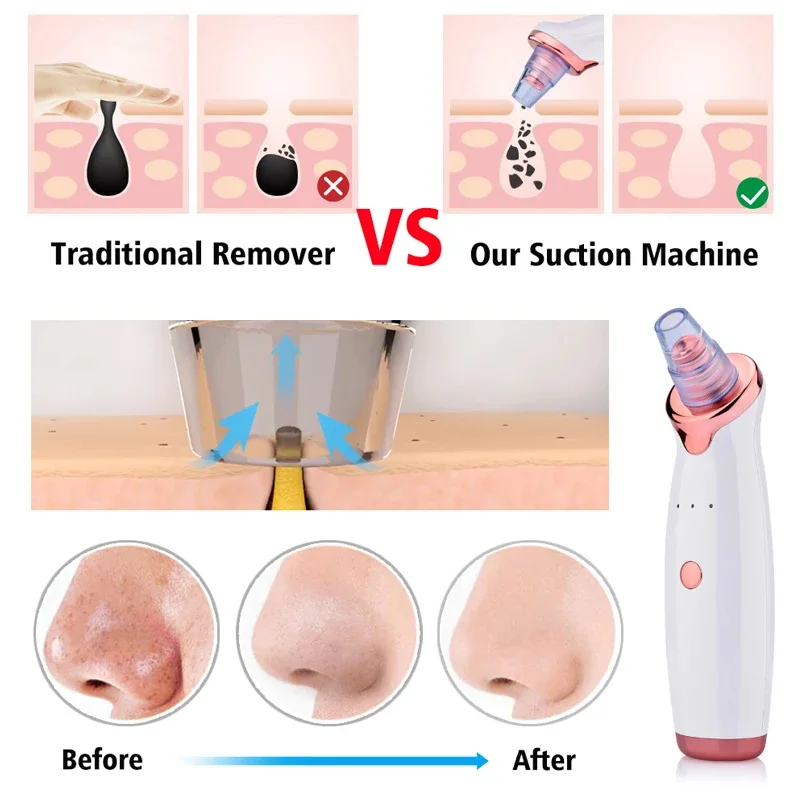 cleaning instrument جهاز إزالة الرؤوس السوداء