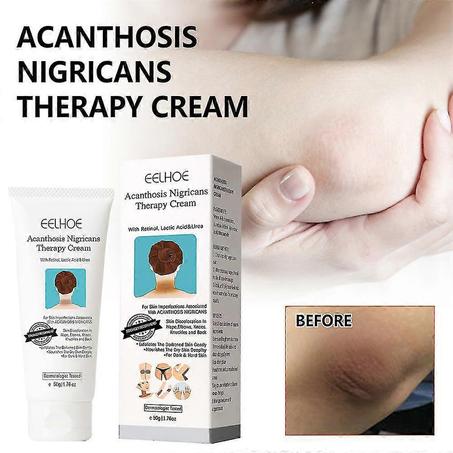 EELHOE 50g acantosis nigricans terapia crema