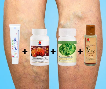 التخلص من الدوالي