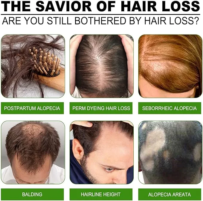 بخاخ الزنجبيل لعلاج تساقط الشعر