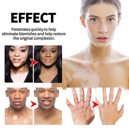 Pommade De Traitement Du Vitiligo