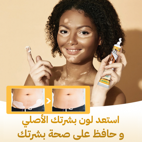 كريم التخلص من البهاق والبقع البيضاء
