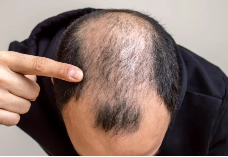زيت مضاد لتساقط الشعر (30 جرام)