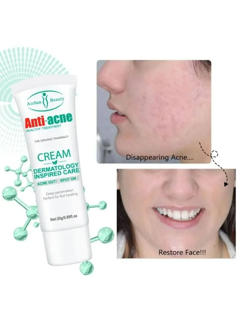 Crème Anti-acnés, élimine les boutons, les comédons , les peaux grasses et l'aspect huilé du visagela , Crème Anti-acné de la marque Aichun Beauty, un soin visage présenté en tube de 20 g. FC