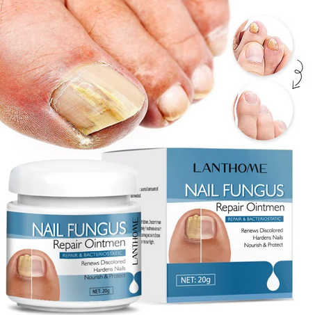 SenCare™ Crème Antifongique Ongles | Traitement Rapide Paronychie & Infections Pieds