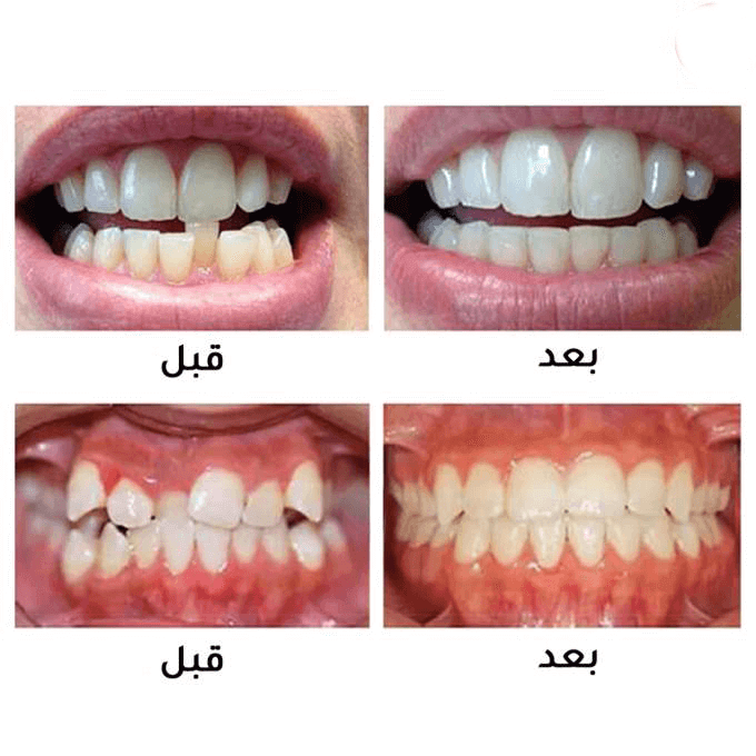 جهاز تقويم الأسنان الأصلي