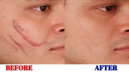Magic scar removal cream
