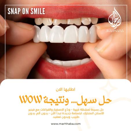 فينير الأسنان المتحرك