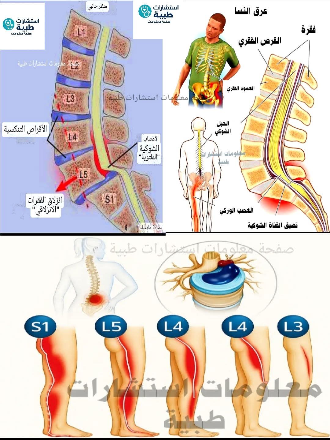 حجامة على العمود الفقري