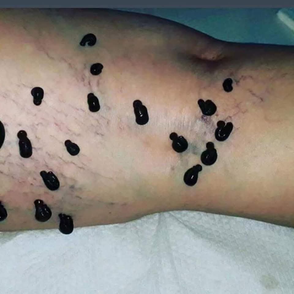 لعلاج بدودة العلق (الحجامة بالعلق)