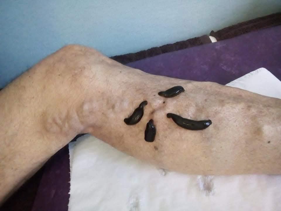 لعلاج بدودة العلق (الحجامة بالعلق)