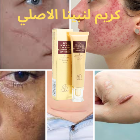 كريم لمبينا الاصلي مزيل اثار الجروح و الحروق حب الشباب و التصبغات الجلدية