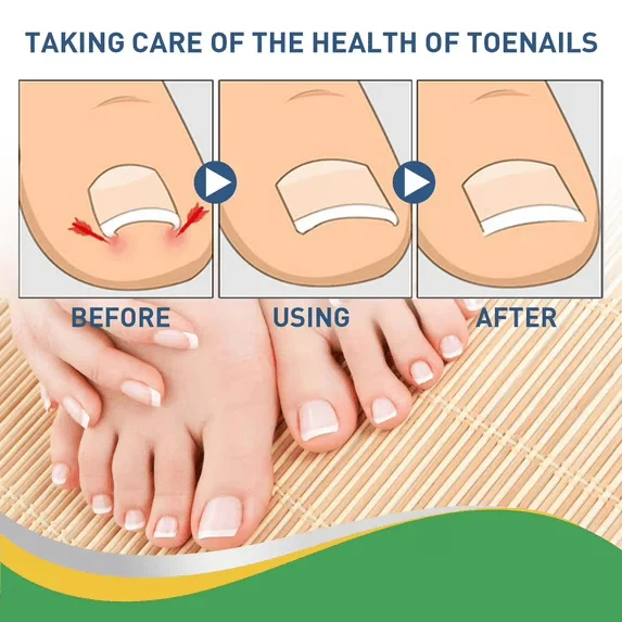 العناية بالظفر قبل وبعد التصحيح