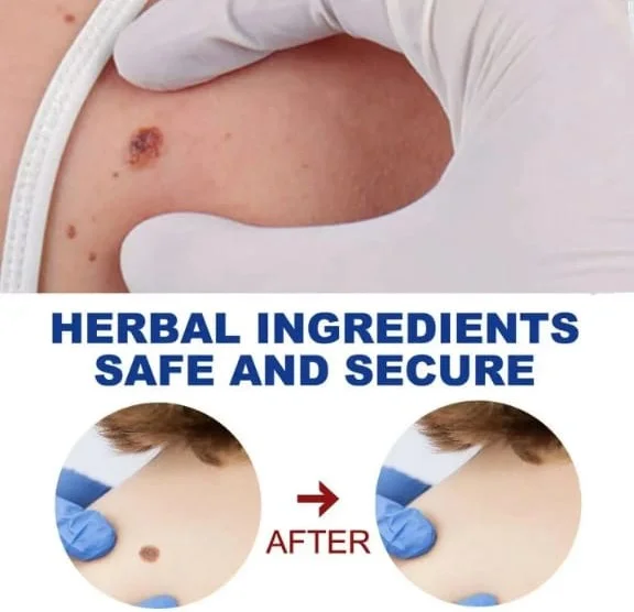 كريم إزالة البُقَع الجلدية