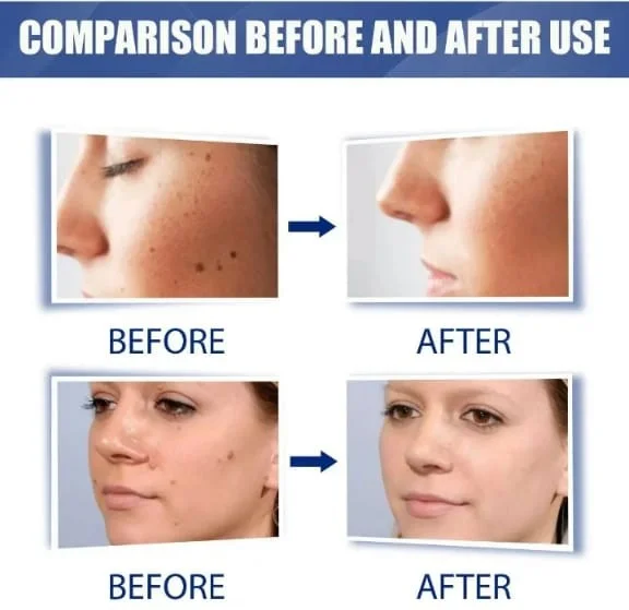 كريم إزالة البُقَع الجلدية