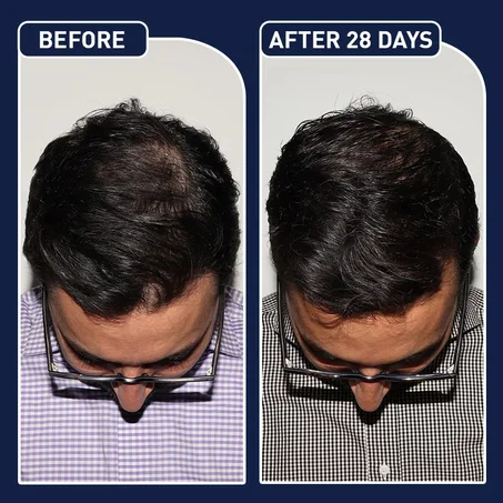 رذاذ تسريع نمو الشعر