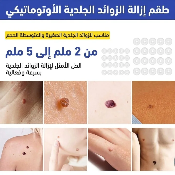 جهاز إزالة الزوائد الجلدية والثآليل المطور 2 في 1 طقم منزلي متكامل لإزالة الزوائد اللحمية بشكل نهائي وآمن بدون ألم أو ترك ندوب على البشرة.