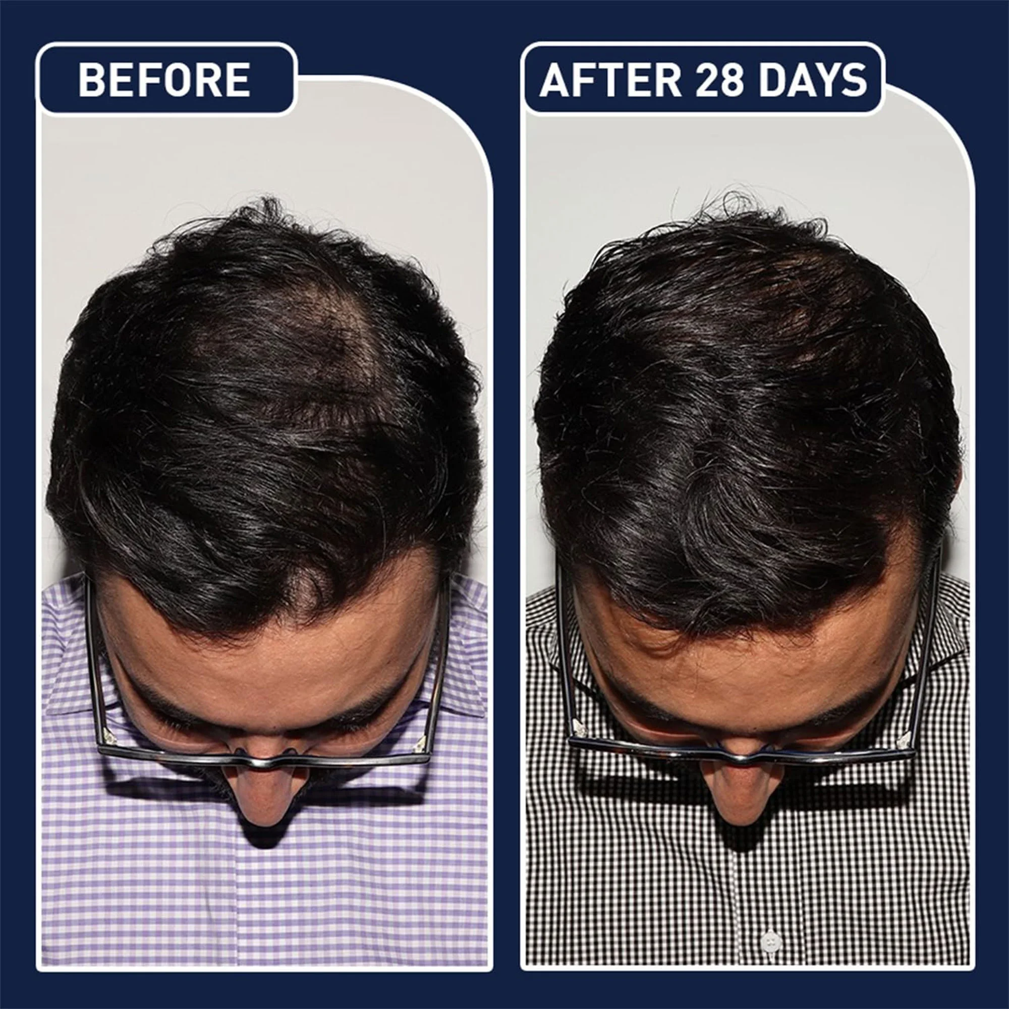 بخاخ نمو وتغذية الشعر . [ ٪38 خصم على القطعتين ]