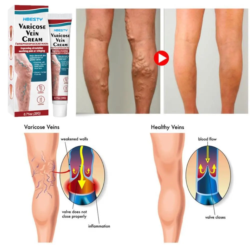 كريم لتخفيف والقضاء على الدوالي