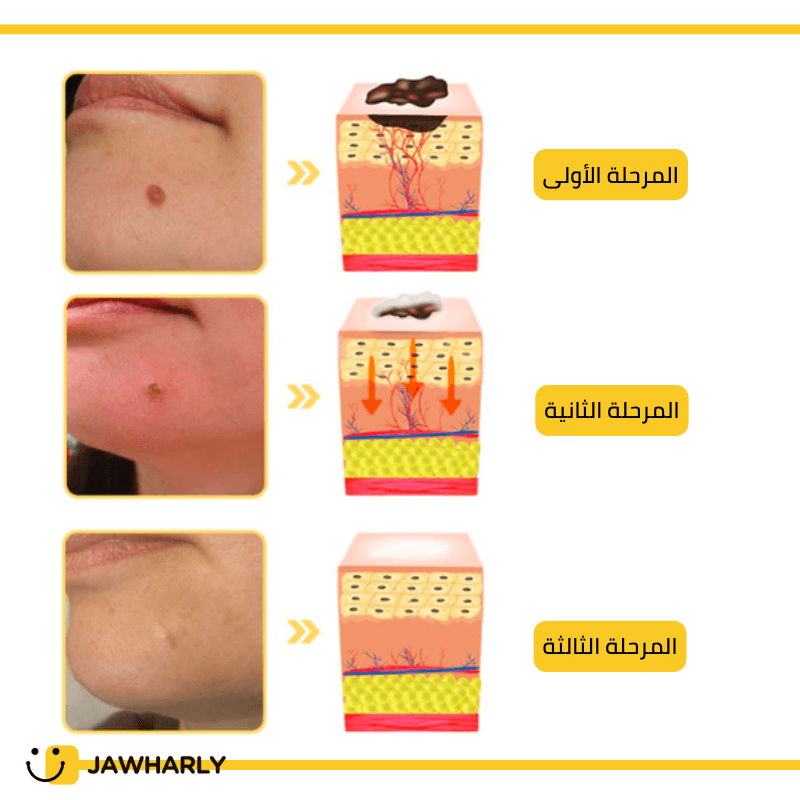 Jawharly™ - بخاخ لإزالة الزوائد الجلدية بتركيبة طبيعية
