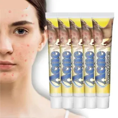 Acne Removal Cream - كريم إزالة حب الشباب