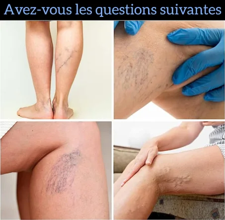 ÉRADIQUER LES VARICES