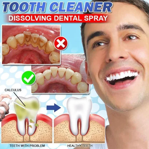 Tartar-free dissolving dental spray