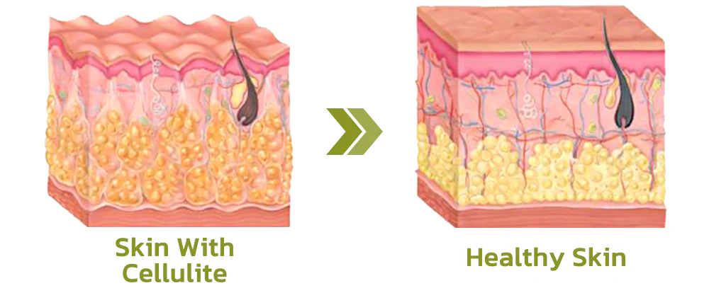Patchs anti-cellulite HerbalLegs
