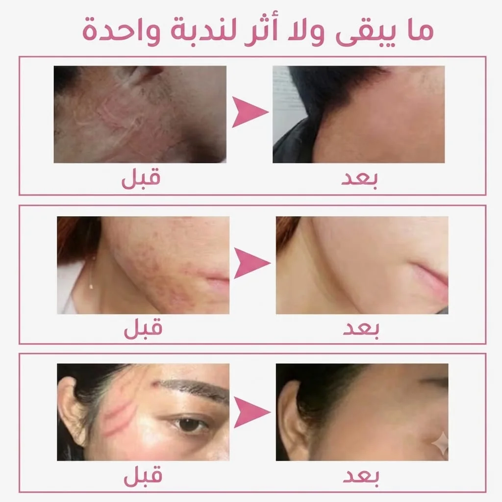 كريم إيلايمي (ELAIMEI) الأصلي لإزالة الندوب وآثار الحمل والجروح - سر البشرة النقية