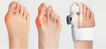 جديد كبير اصبع القدم الورم مستقيم قابل للتعديل