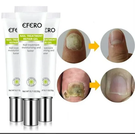 “Cracked, Yellow, or Brittle Nails? Restore Their Natural Beauty in Just 7 Days!” 🌿