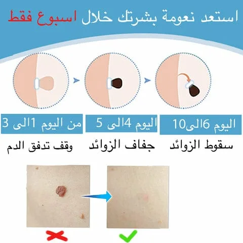 قلم إزالة الثآليل ذو الرأسين