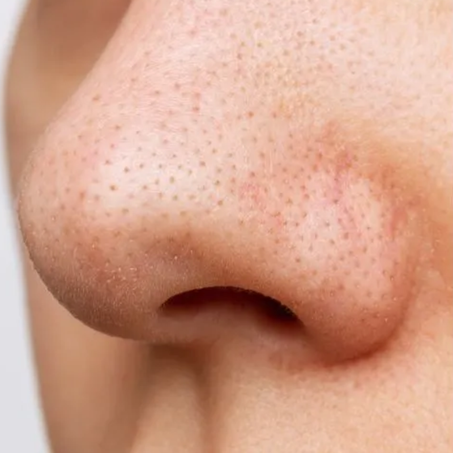 أسباب ظهور الرؤوس السوداء وطرق فعالة لعلاجها نهائيًا