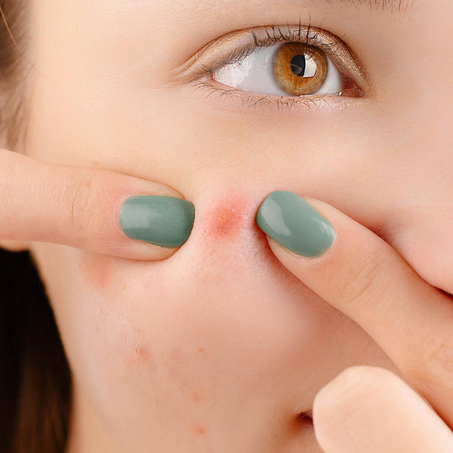 طريقة التخلص من آثار الحبوب بسرعة