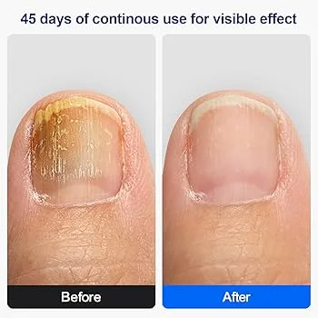 Appareil Anti-Mycose – Solution Complète pour Ongles et Peau