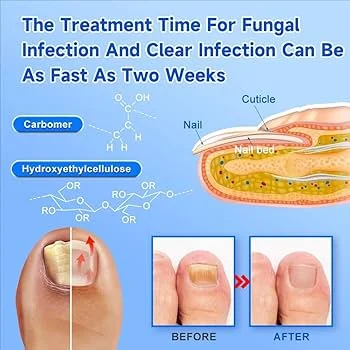 Appareil Anti-Mycose – Solution Complète pour Ongles et Peau