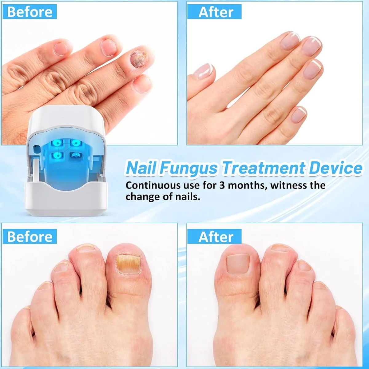 Appareil Anti-Mycose – Solution Complète pour Ongles et Peau