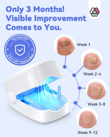 Appareil Anti-Mycose – Solution Complète pour Ongles et Peau